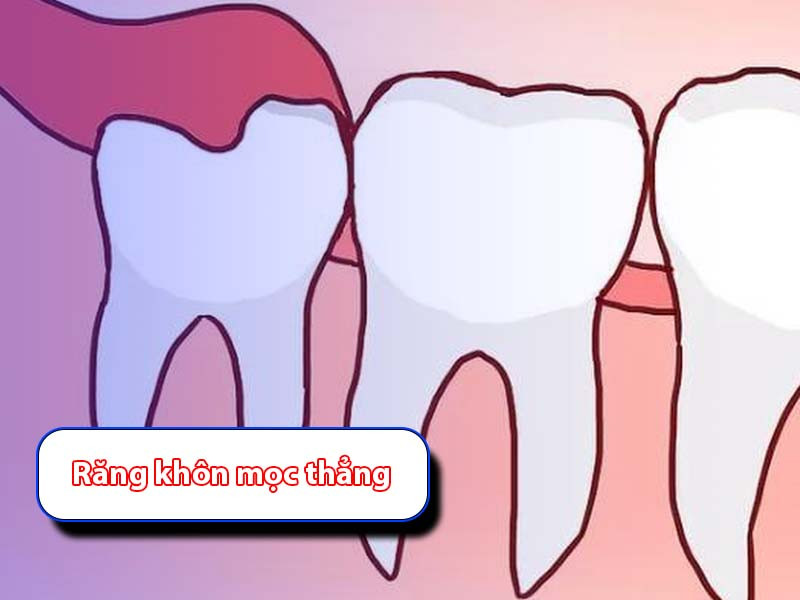 Răng khôn mọc thẳng: Nguy Cơ, Biến Chứng & Cách xử lý 